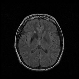 Caudate Nucleus Atrophy As An Early Finding Of Neuroferritinopathy ...